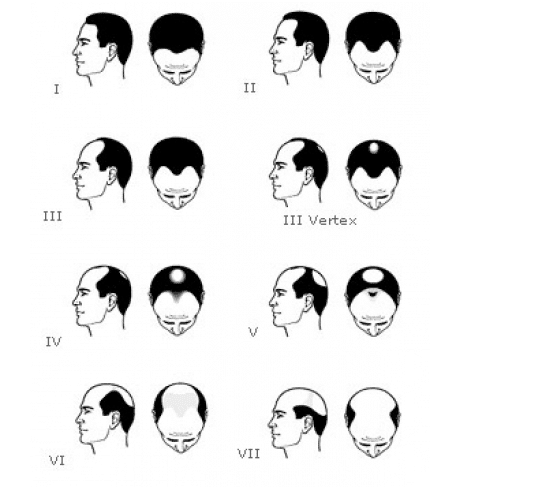 Les phases du schéma Hamilton-Norwood - Centre de Greffe de cheveux