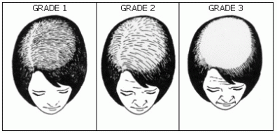 Classification de la calvitie androgénétique chez la femme - Greffe de cheveux