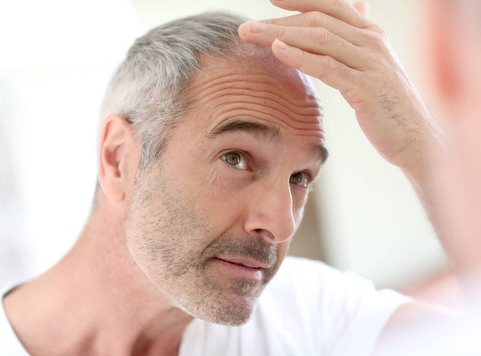 Perte de cheveux chez l’homme et traitements - Greffe de cheveux