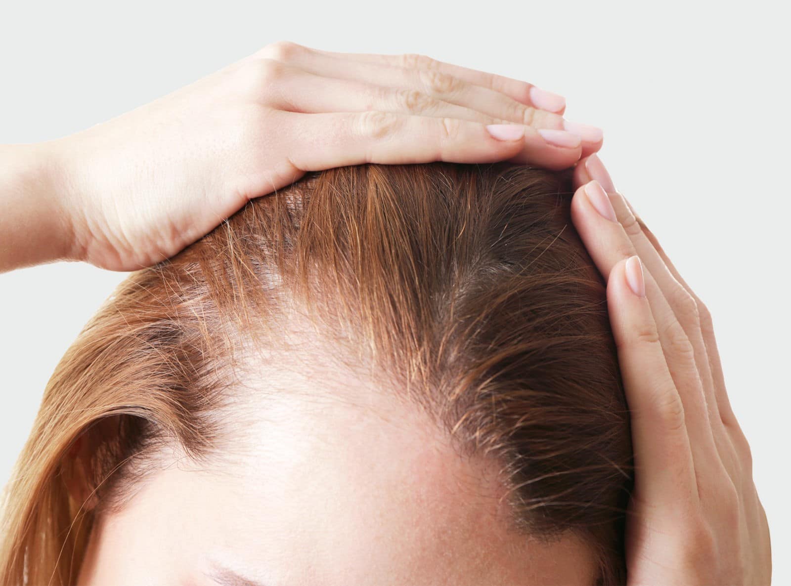 Perte de cheveux chez la femme et traitements - Greffe de cheveux