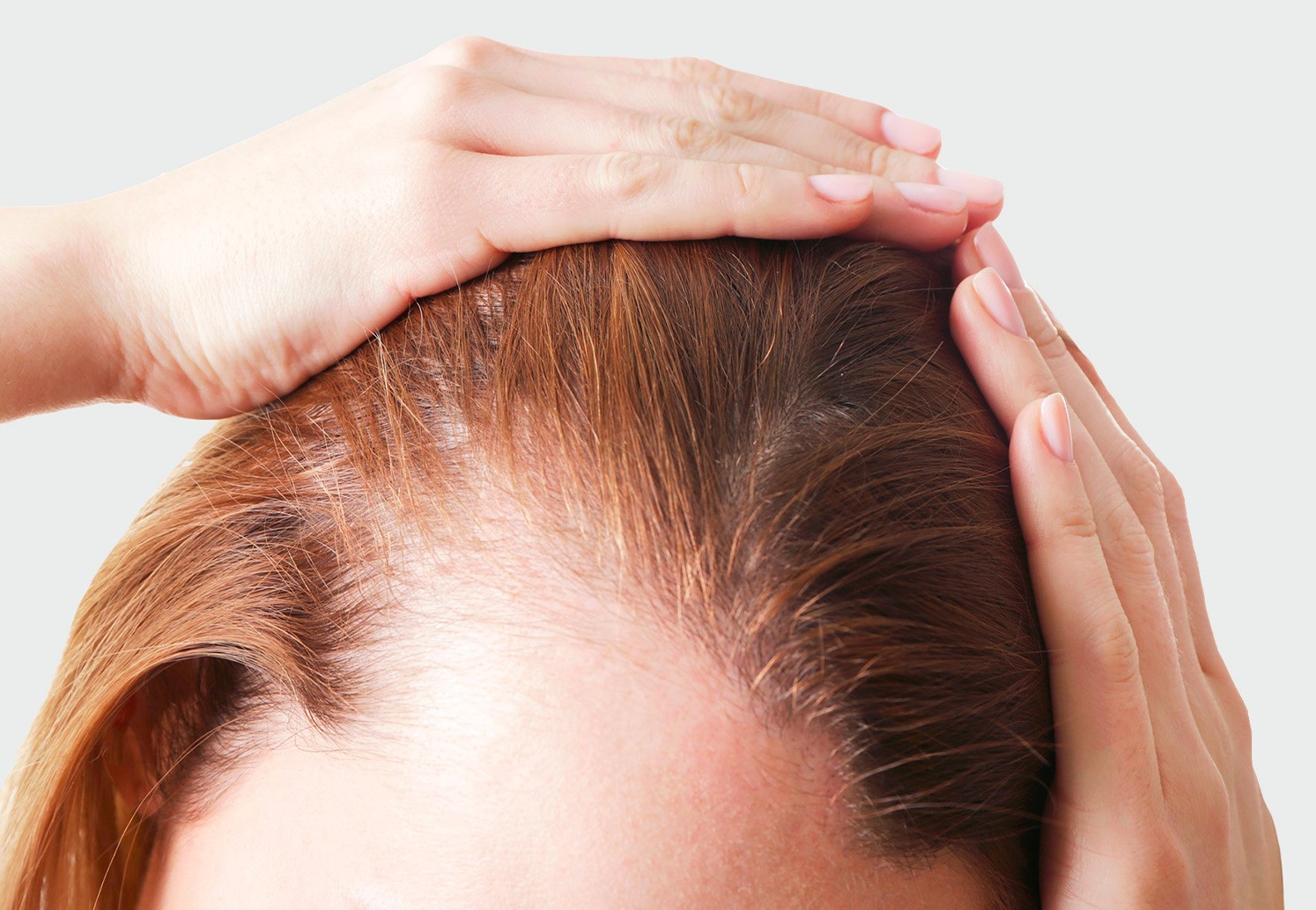 Perte de cheveux chez la femme traitement à Paris - Greffe de cheveux