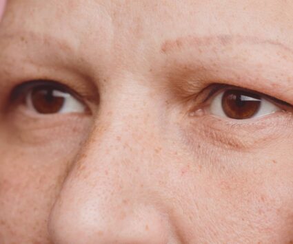Quelles sont les causes d’une perte des sourcils ?| Paris