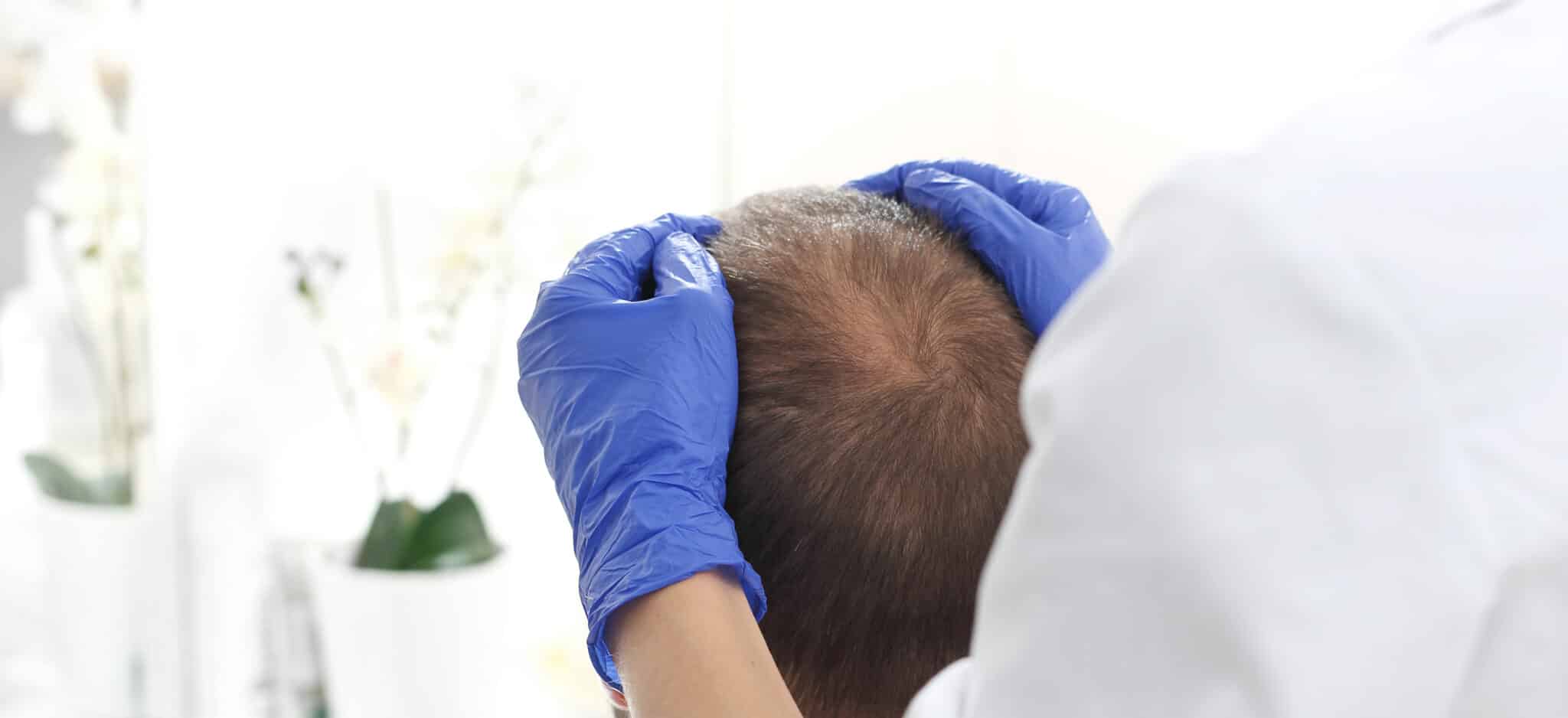 alternatives implants capillaires