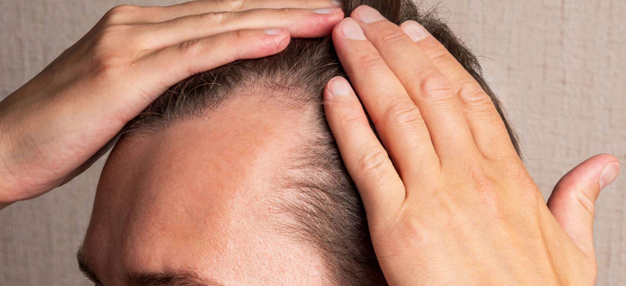 greffe cheveux alopécie avancée quelles sont limites | Paris | Centre de Greffe de cheveux
