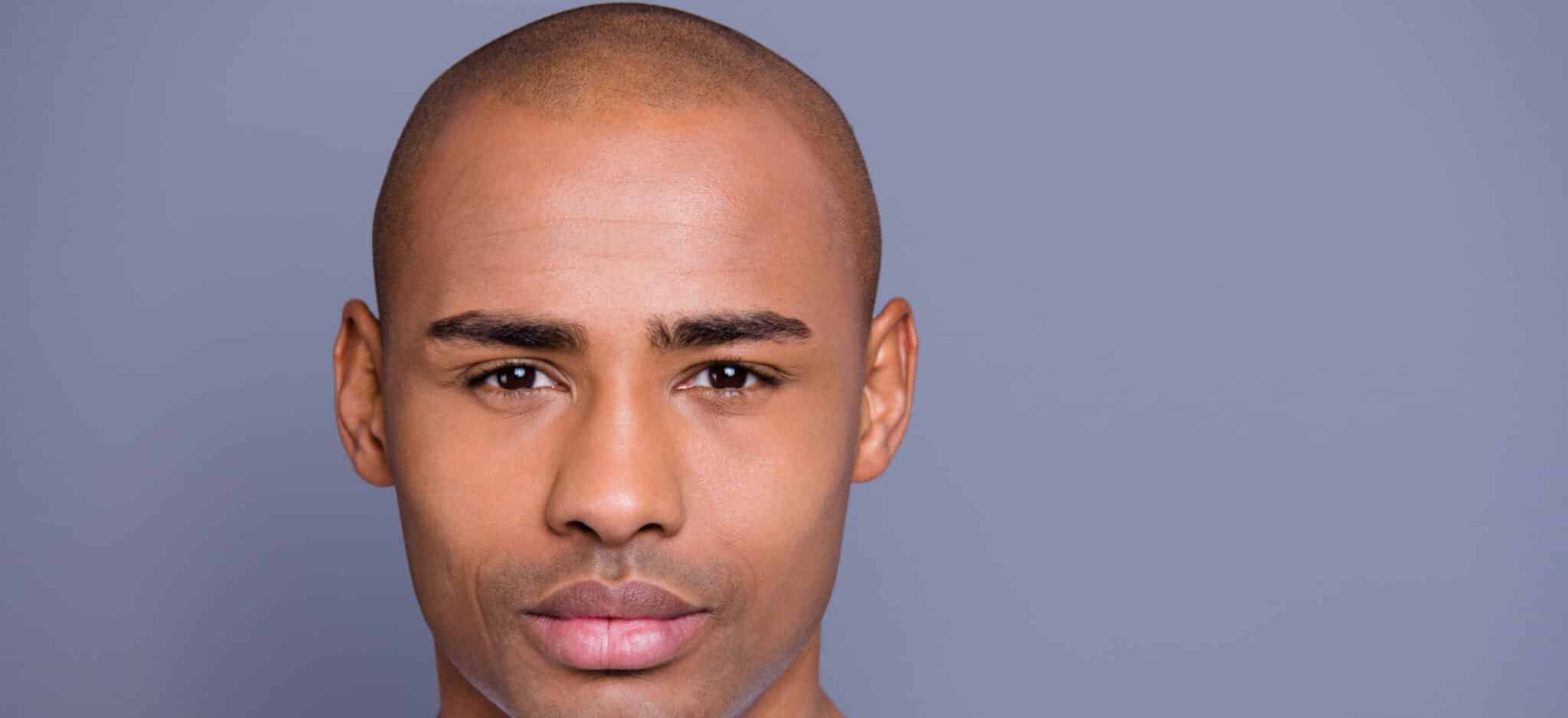 Peut-on réaliser deuxième greffe cheveux première insuffisante | Paris | Centre de Greffe de cheveux