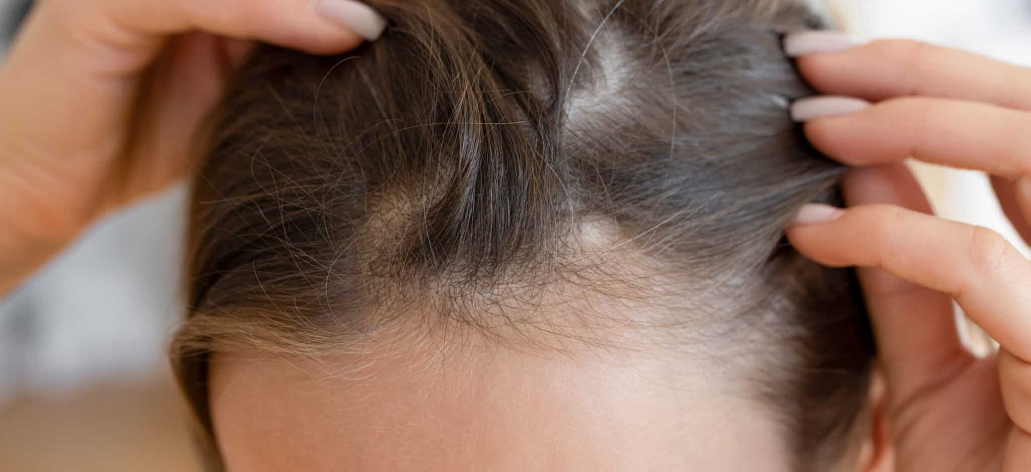 Greffe cheveux traitement PRP combinaison efficace | Paris | Centre de Greffe de cheveux