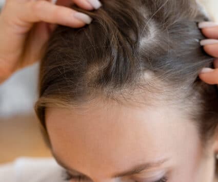 Greffe cheveux traitement PRP combinaison efficace | Paris | Centre de Greffe de cheveux