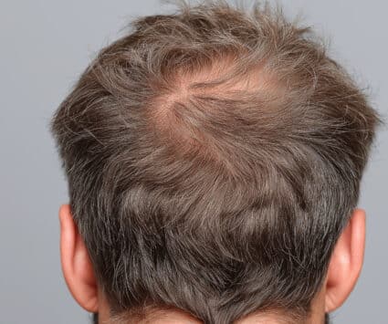 stress perte cheveux quelles solutions médecine esthétique | Paris | Centre de Greffe de cheveux